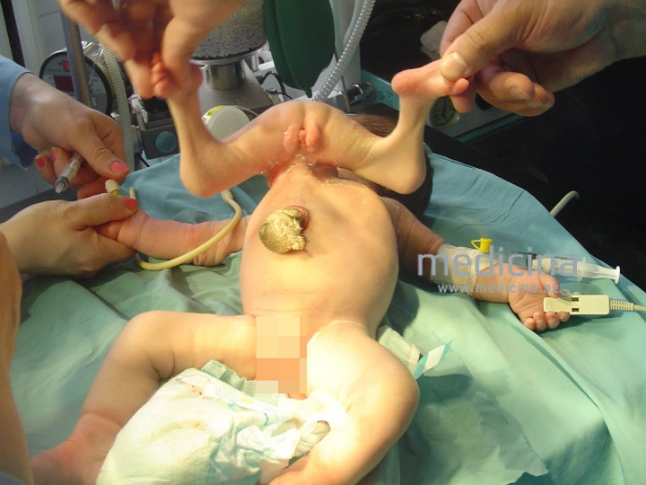 В Азербайджане родился ребенок с четырьмя руками и ногами - ФОТО