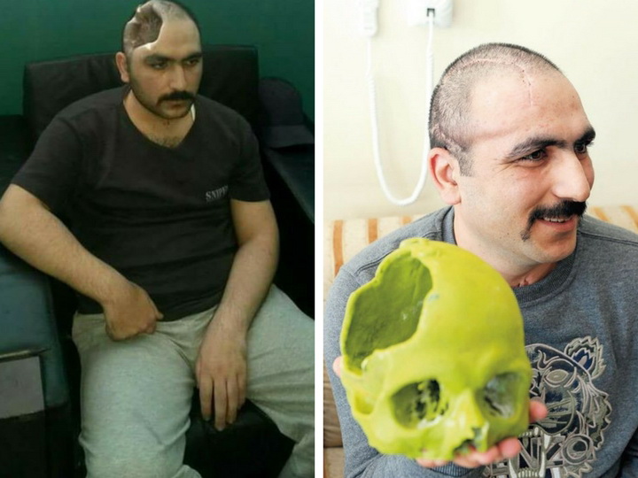 Тяжело раненный в апрельских боях военнослужащий: Я вернусь в азербайджанскую армию! - ФОТО