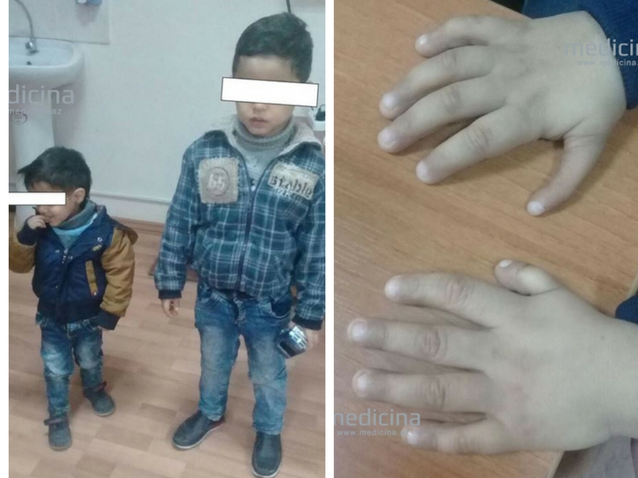 В Азербайджане у одного из братьев-близнецов обнаружен редкий генетический синдром – ФОТО