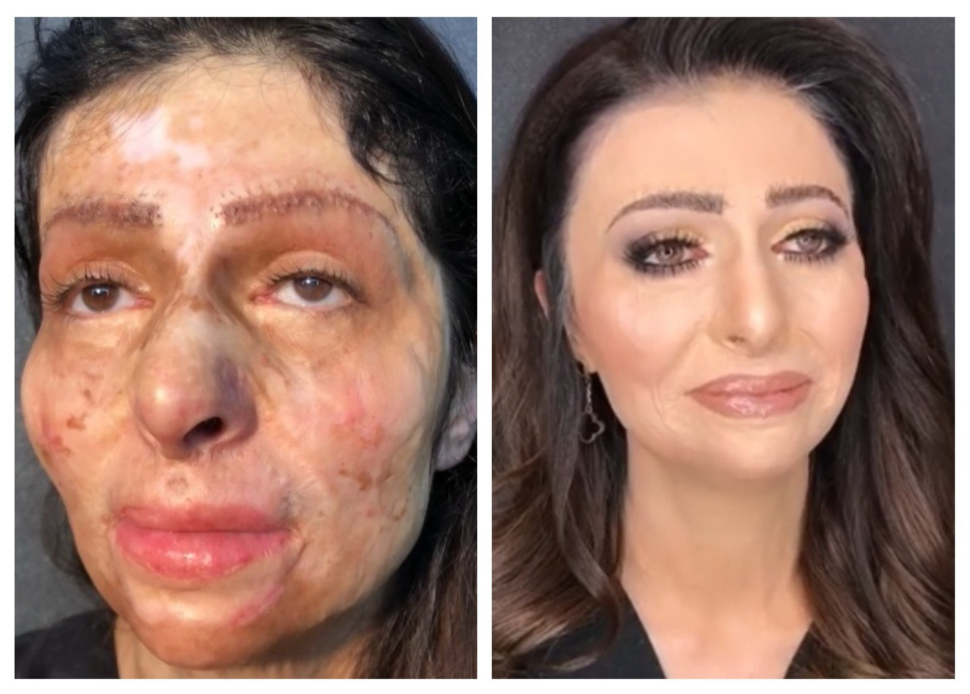Реакция азербайджанки с обезображенным лицом на первый макияж растрогала пользователей соцсетей – ВИДЕО  