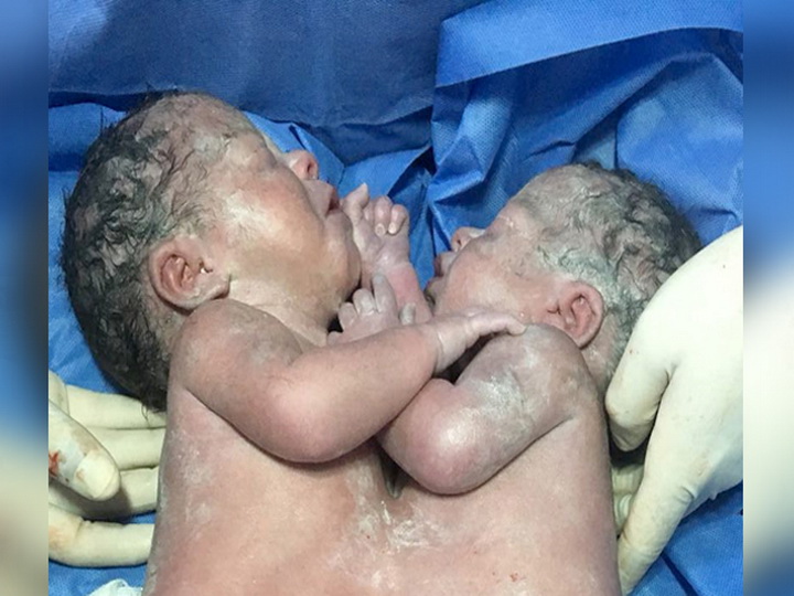 В Мексике успешно разделили новорожденных сиамских близнецов – ФОТО
