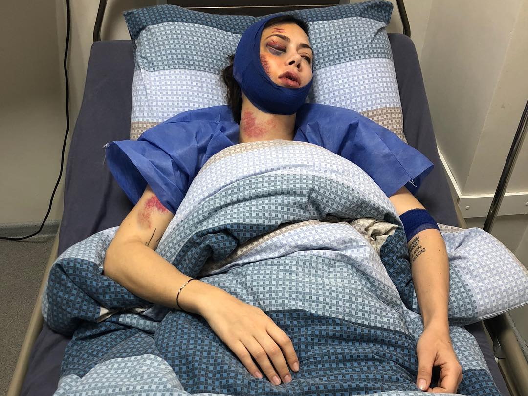 Исчезла жестоко избитая Настасья Самбурская – ФОТО – ОБНОВЛЕНО