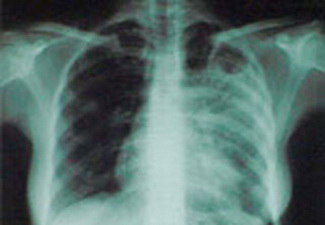 Смертность от туберкулеза в пенитенциарных учреждениях Баку сократилась в 35 раз