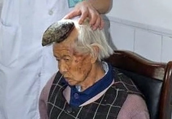 У пожилой китаянки на голове вырос 13-сантиметровый рог – ФОТО