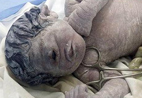 В Египте родился «ребенок-циклоп» с одним глазом на лбу – ФОТО - ВИДЕО