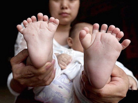 В Китае родился ребёнок с 31 пальцем на руках и ногах