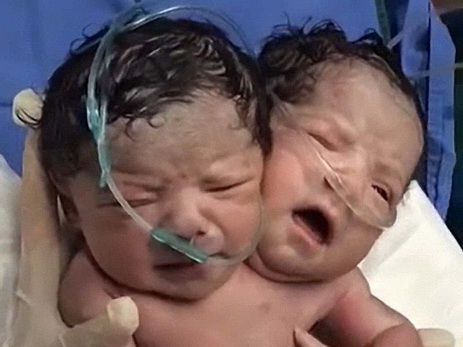 В Мексике родился ребенок с двумя головами - ФОТО - ВИДЕО